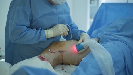 leg ulcer wound in treatment for varicose veins in phlebology procedure. bonding of veins using bioglue