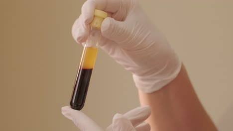 platelet-rich plasma preparation. tube with blood in hands.