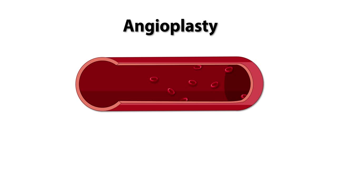Visual guide to balloon angioplasty process