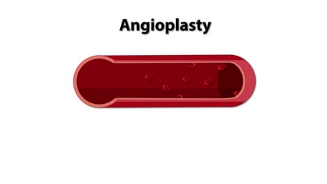 visual guide to balloon angioplasty process