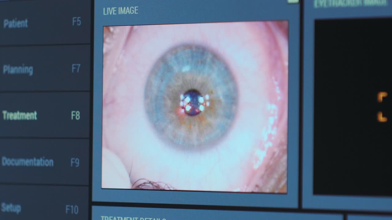 Ophthalmic surgery. View on the screen of medical monitor in operating room. Lasik