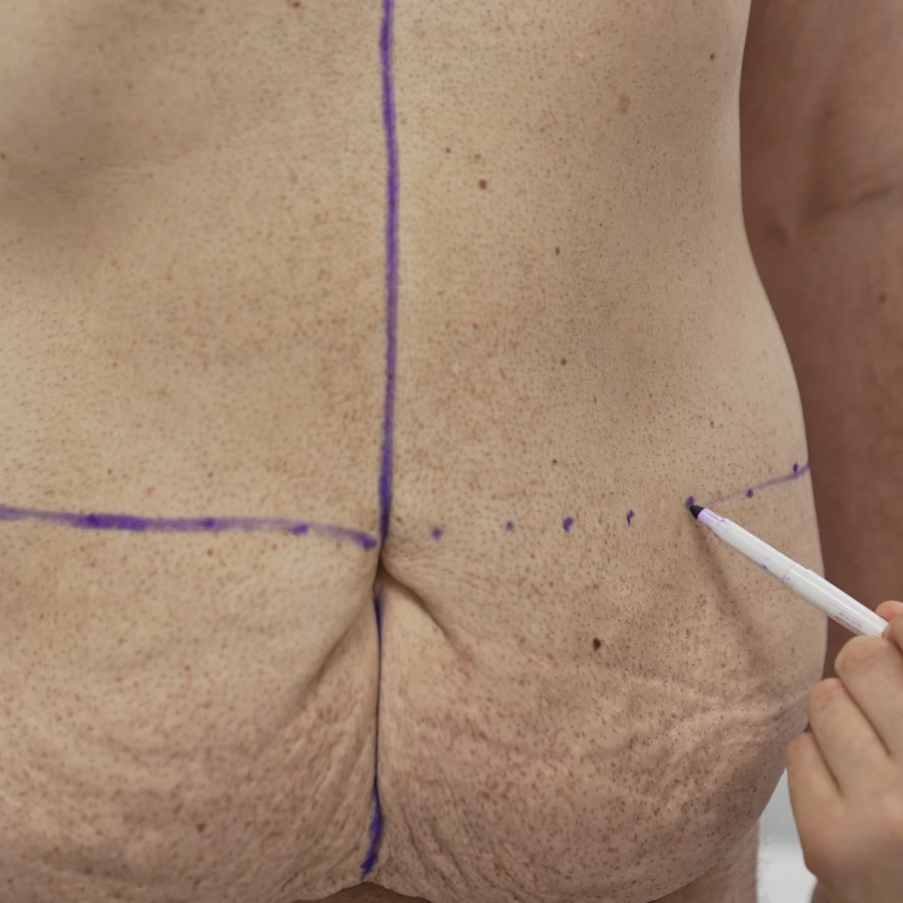Doctor marks problem zones on patient's belly. Preparation man's body marking abdomen for the plastic surgery. Close-up. Result of weight loss
