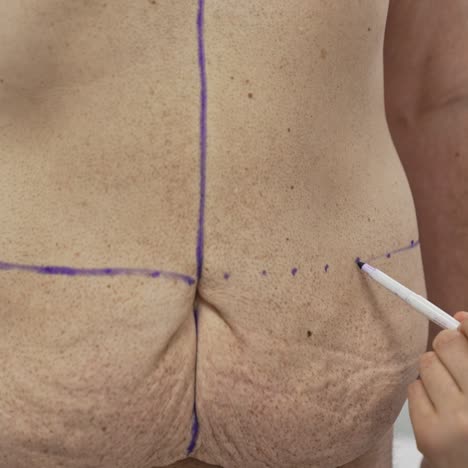 doctor marks problem zones on patient's belly. preparation man's body marking abdomen for the plastic surgery. close-up. result of weight loss