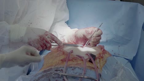 medical staff of the operating unit do heart surgery the nurse assists in performing the operation suturing a wound