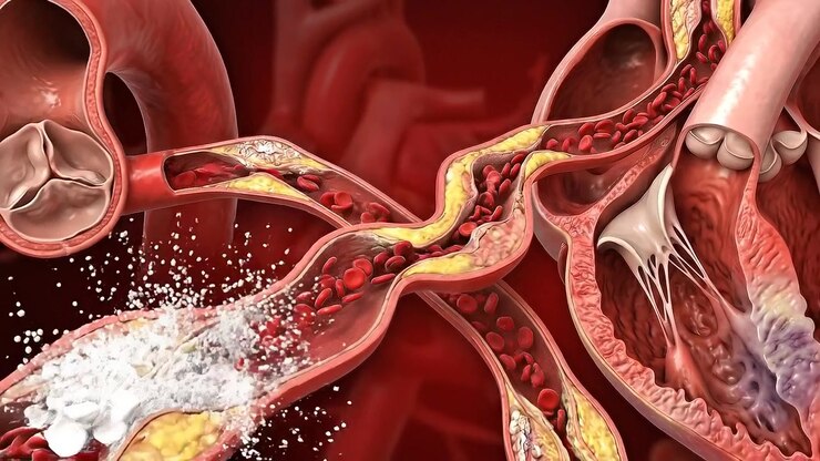 Microscopic Medical Simulation of Cholesterol Plaque Restricting Blood Flow in Artery