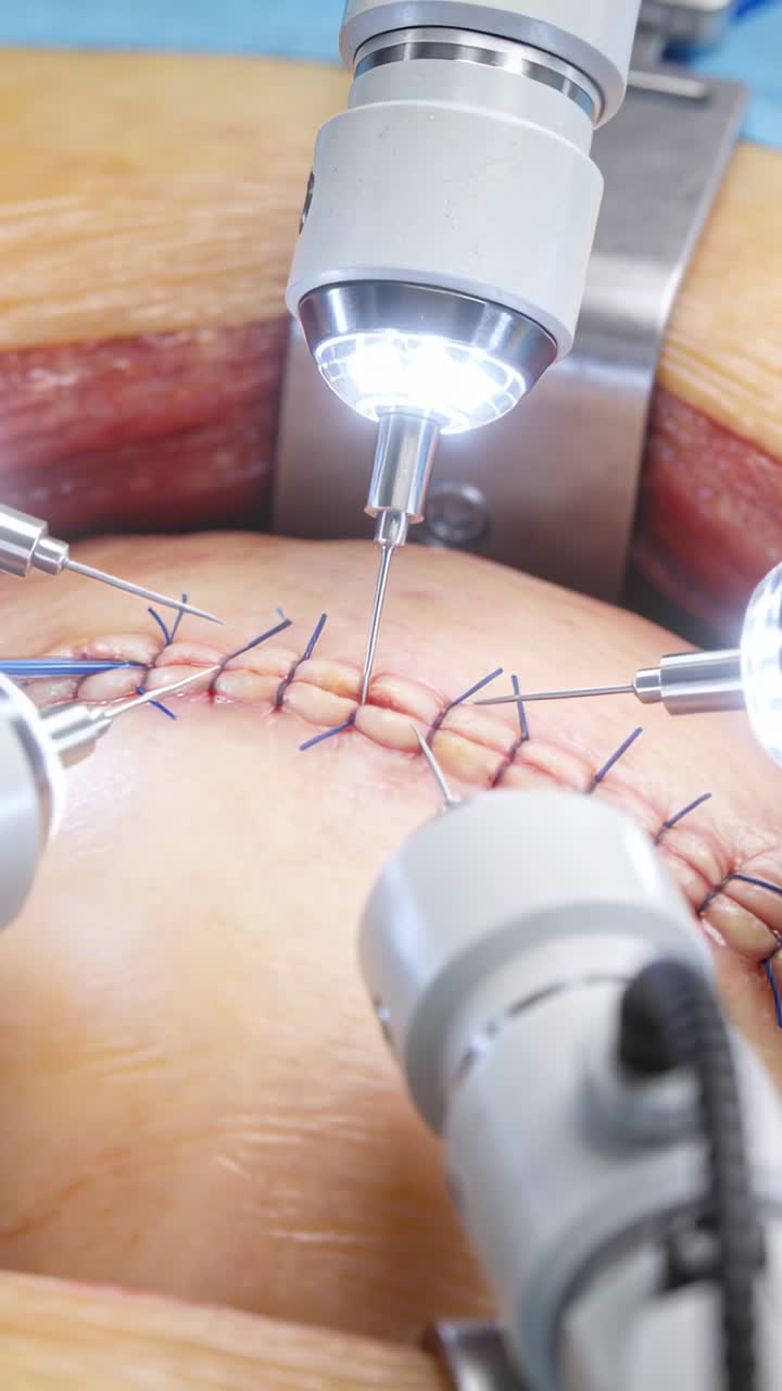 Video verticale: Bracci robotici che suturano, guidando l'ago dopo aver fluttuato per chiudere un'incisione in sala operatoria con suture blu.