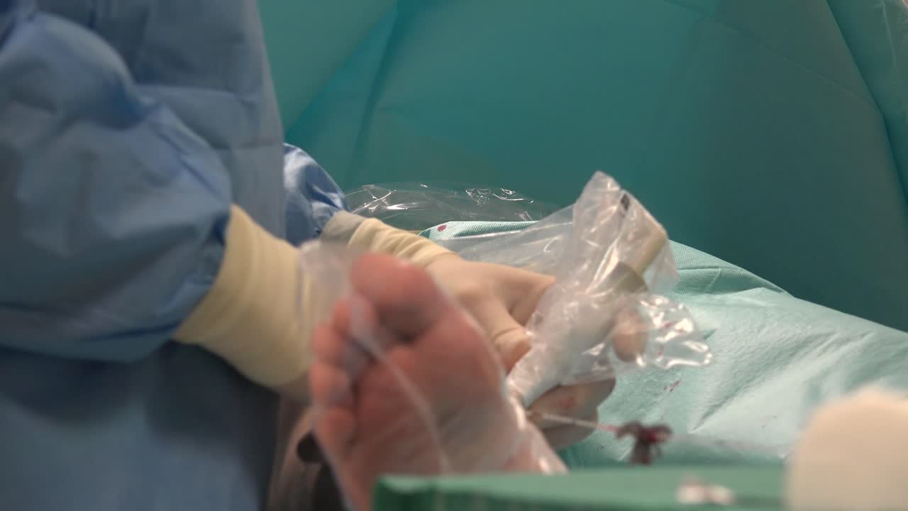 la ablación endovenosa con láser es una terapia mínimamente invasiva muy eficaz y de uso común para controlar las várices en las piernas.