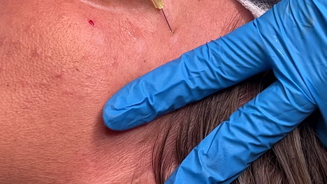 botulinum toxin being injected into the orbicularis oculi muscle for treatment of crows feet lines on a caucasian woman in a medical aesthetics clinic