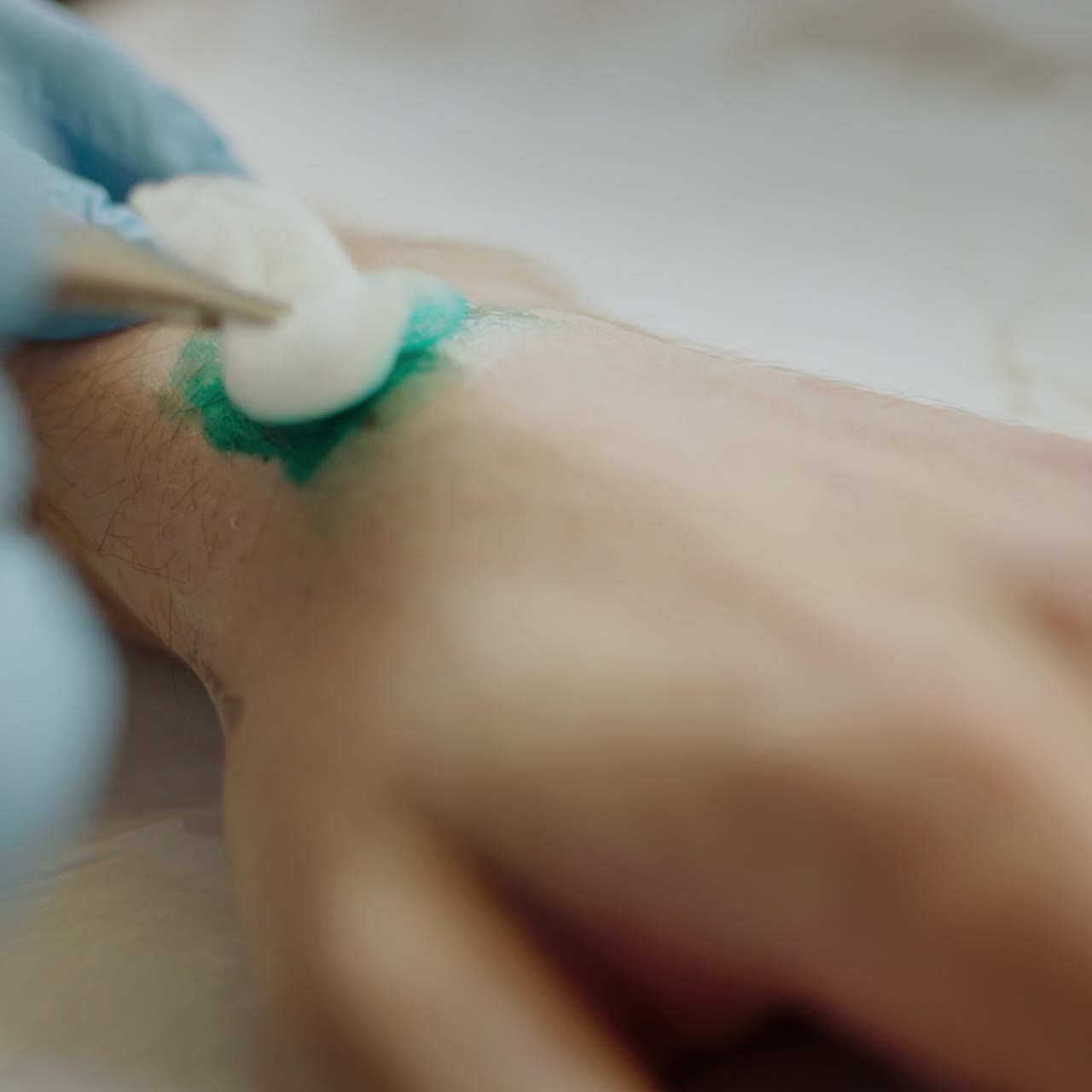 상처에서 제거된 실밥 1