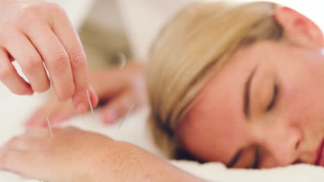 sleeping woman getting acupuncture massage