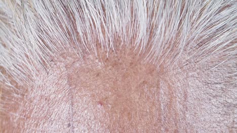 scalp condition with white hair