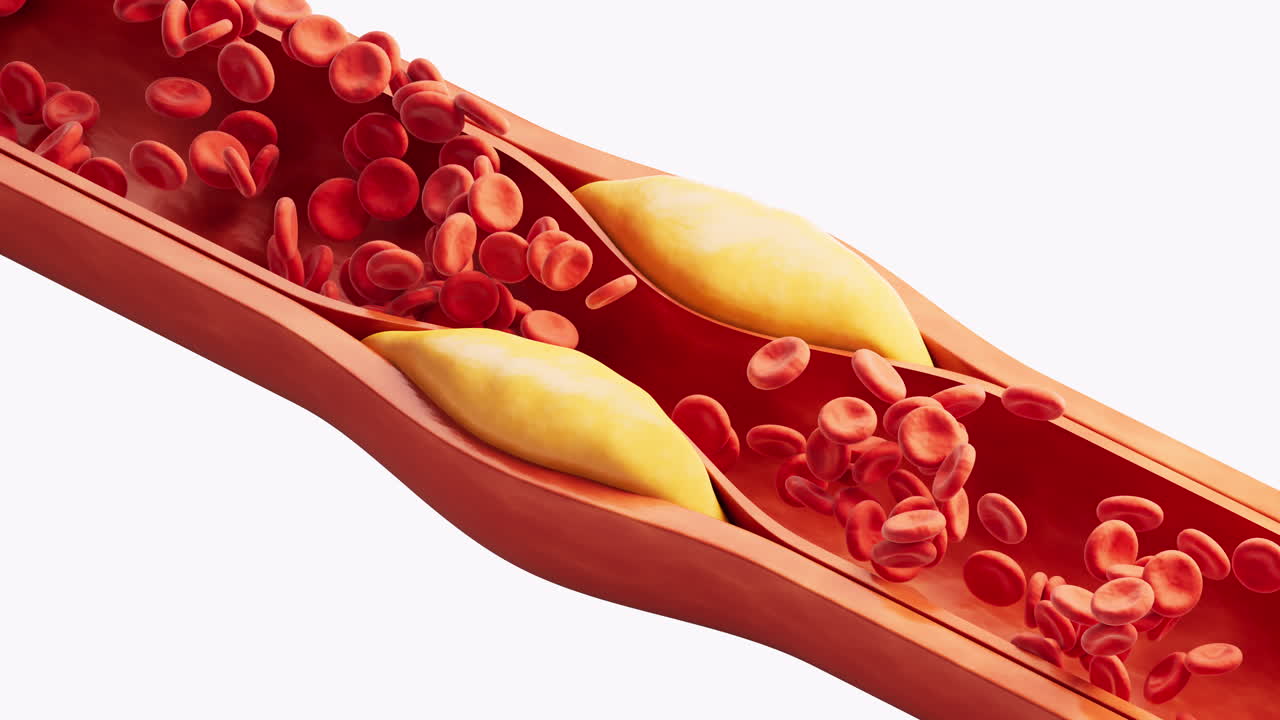 Blood vessel with blood fat in it, 3d rendering