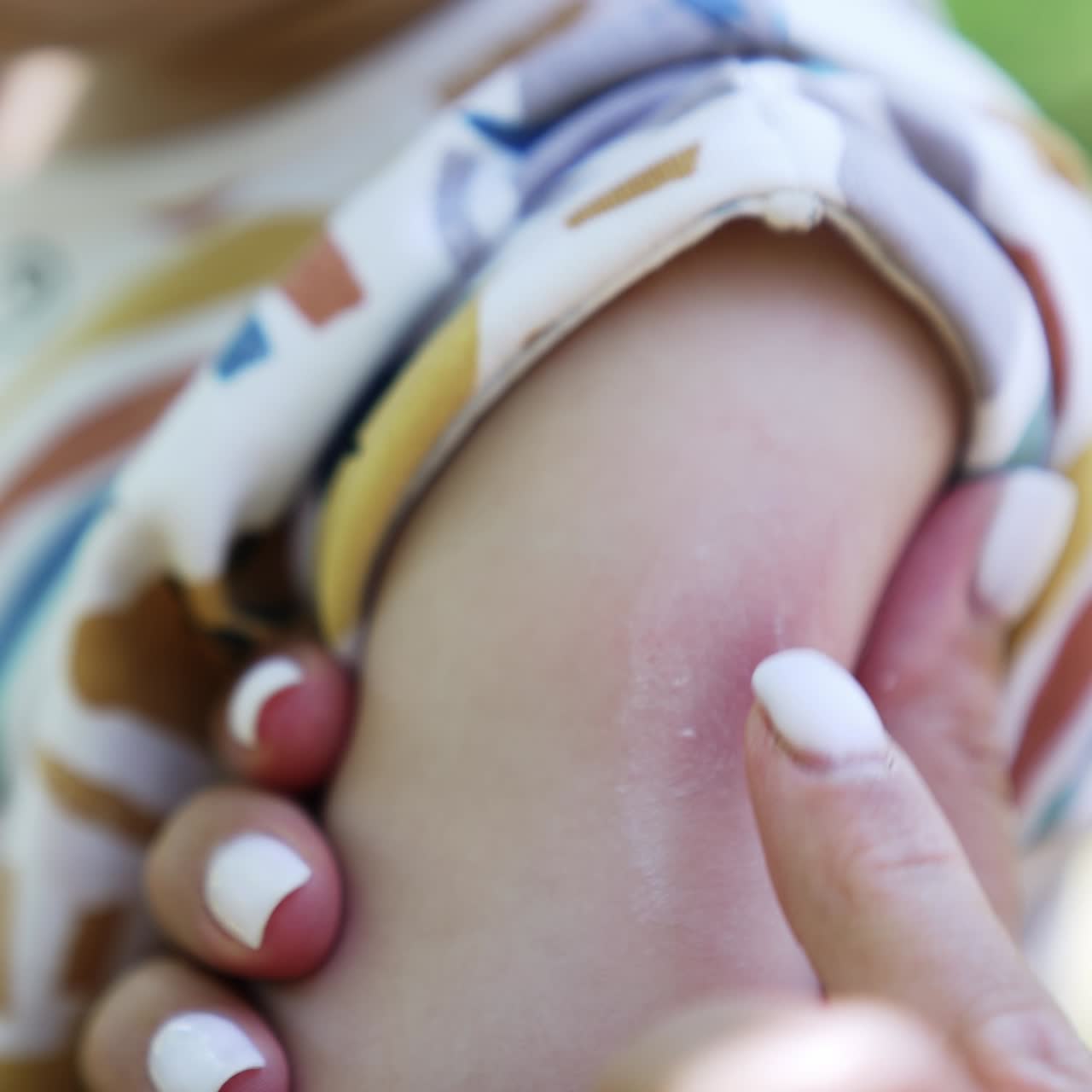 Madre irriconoscibile che allevia il prurito da puntura di zanzara al suo bambino. La mamma applica un po' di unguento sul rossore. Primo piano