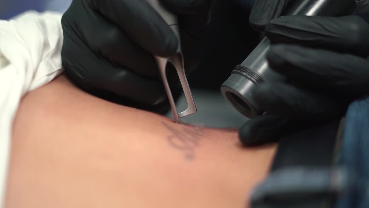Donna che rimuove un tatuaggio, cancellandolo o eliminandolo