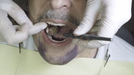 dental procedure in progress, close up of patient’s mouth with tools and gloves