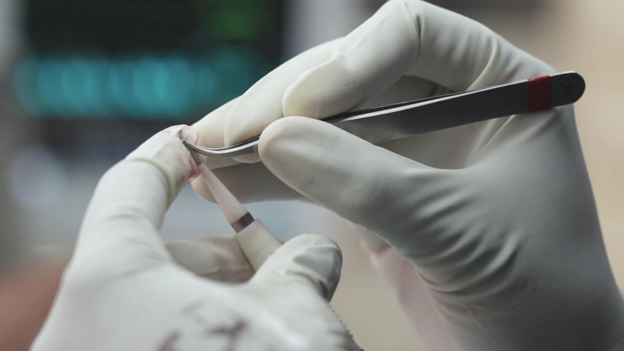 Trapianto di capelli DHI in clinica. Primo piano delle mani dell'infermiera che inserisce il follicolo nella penna implanter Choi con monitor della frequenza cardiaca sullo sfondo