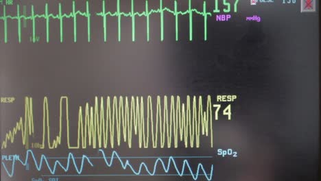 un monitor cardíaco del hospital monitorea a un bebé dentro de su madre embarazada que actualmente está en trabajo de parto