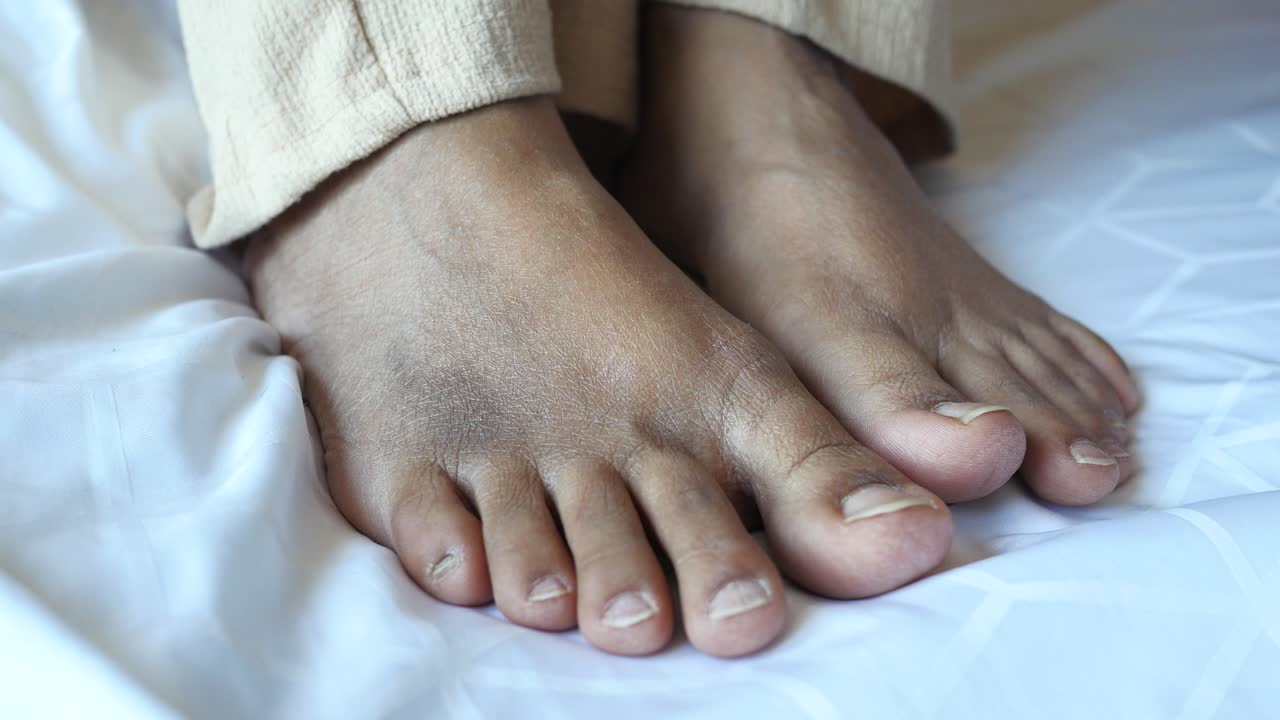Dry, Cracked Feet on a Bed