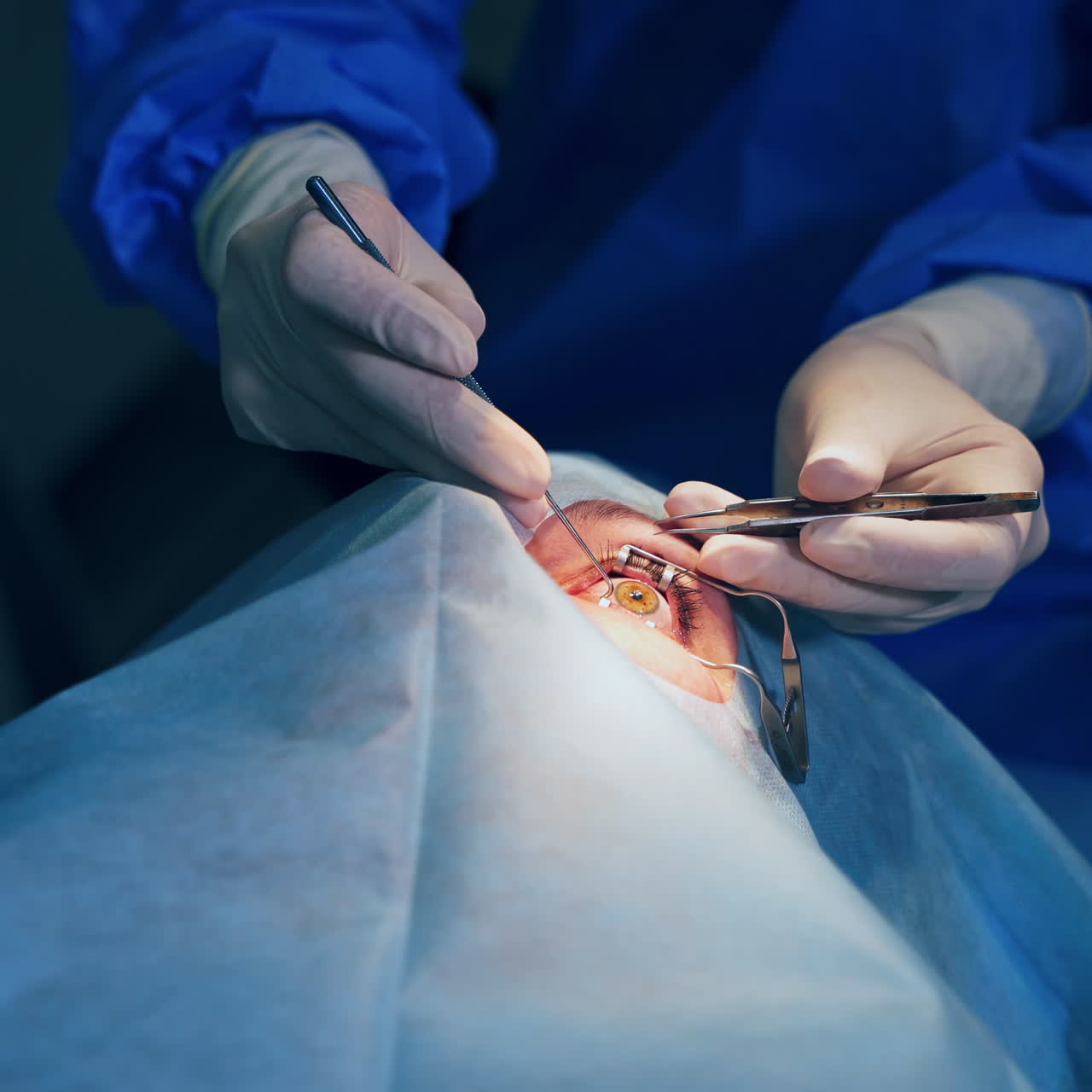 Ophthalmology operation. Surgeon's hands in gloves performing eye vision correction. Modern clinic and equipment. Selective video focus.