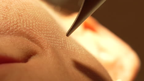 Close-up of skin being treated with a precision tool, showcasing the detail of the pores and the fine skill involved in dermatological procedures