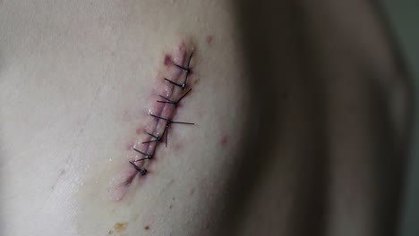 macro extreme close up of large intense stitches on the back of a white male after a surgery