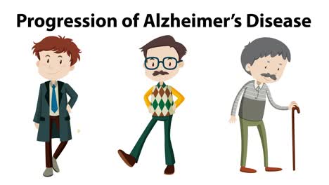 illustrates stages of alzheimer's disease visually