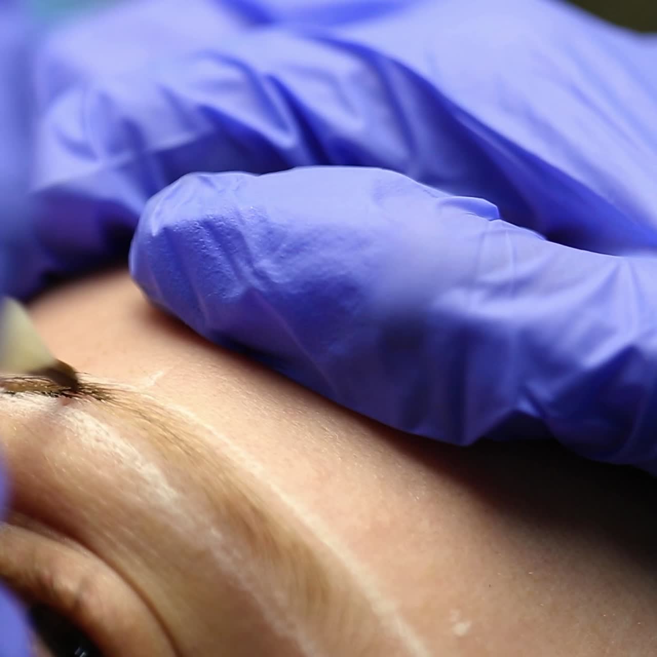 Correction of eyebrows