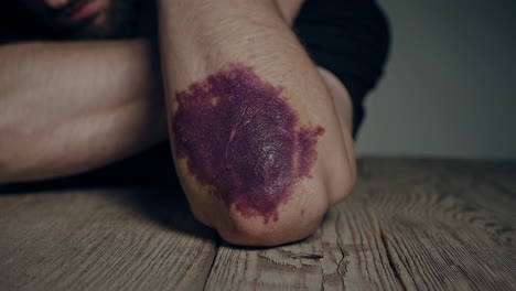 bruised elbow