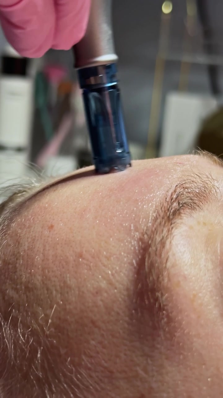 Microneedling-behandling på en hudpleieklinikk med en klient som ligger nede og en enhet som påfører behandlingen på pannen midt på dagen.
