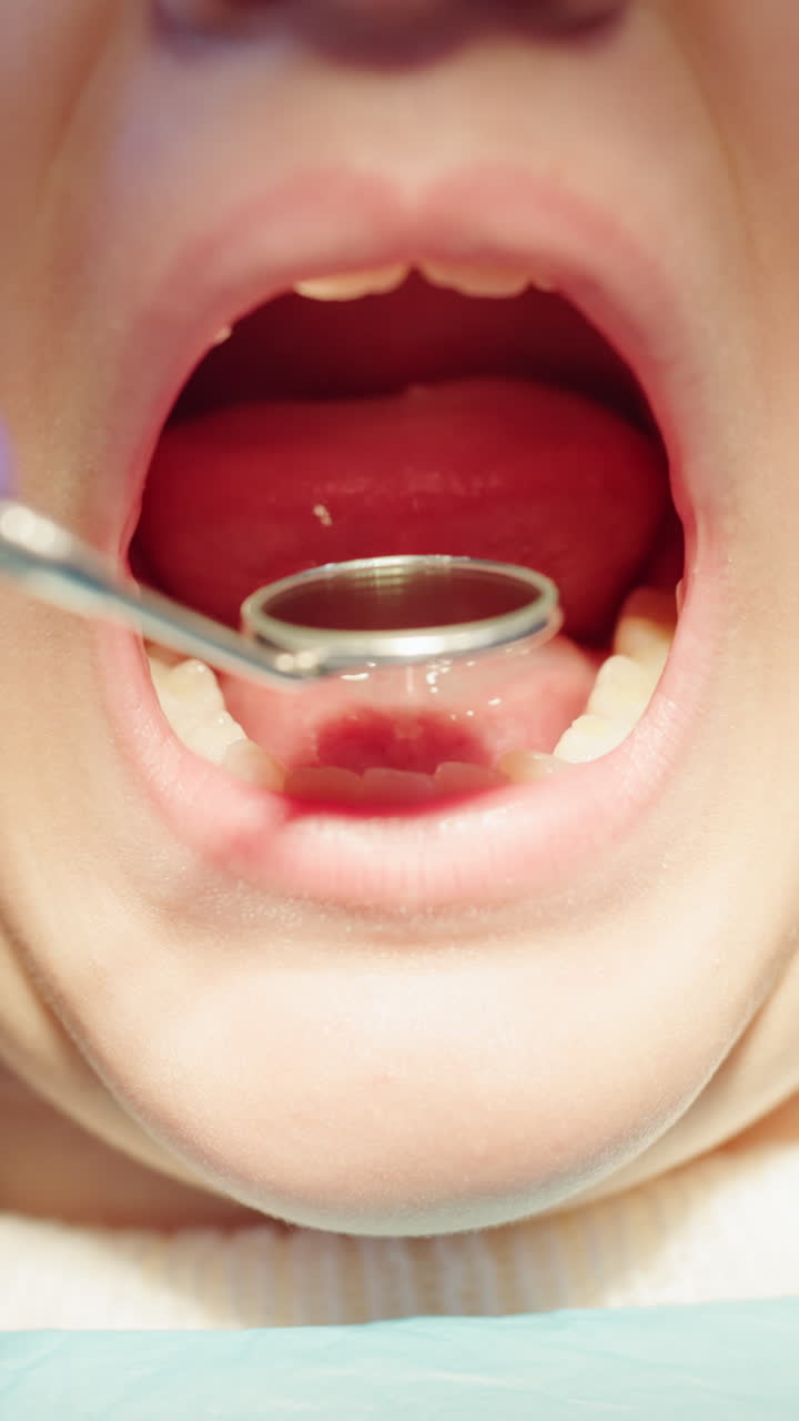 Close-up of Child's Open Mouth During Dental Examination