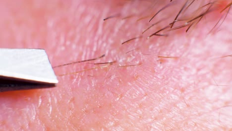 4k super macro shot of hair removal with tweezers, on a caucasian person, at an extreme close up, in a studio