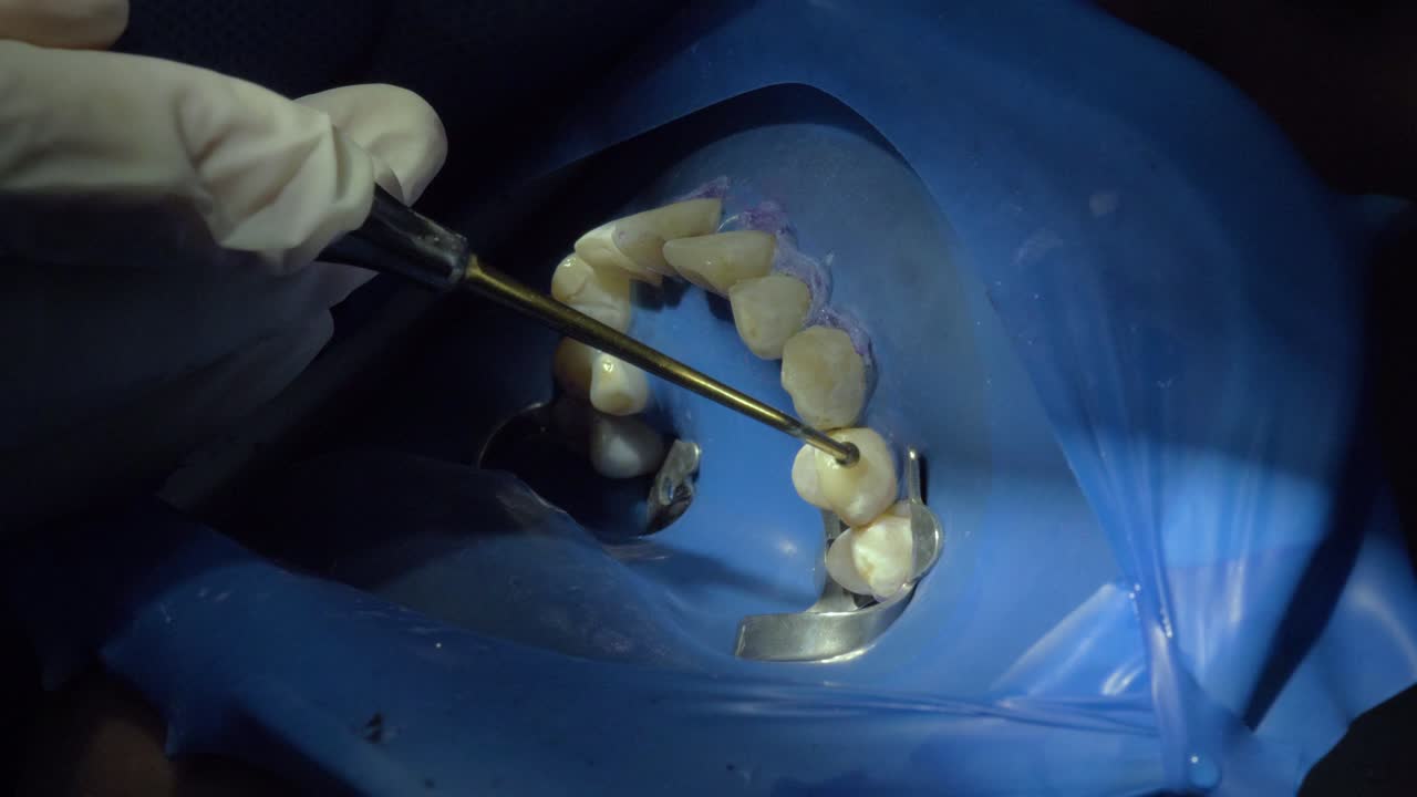 정확한 치과 도구로 치아를 조각하여 완벽한 적응과 기능을 보장합니다.