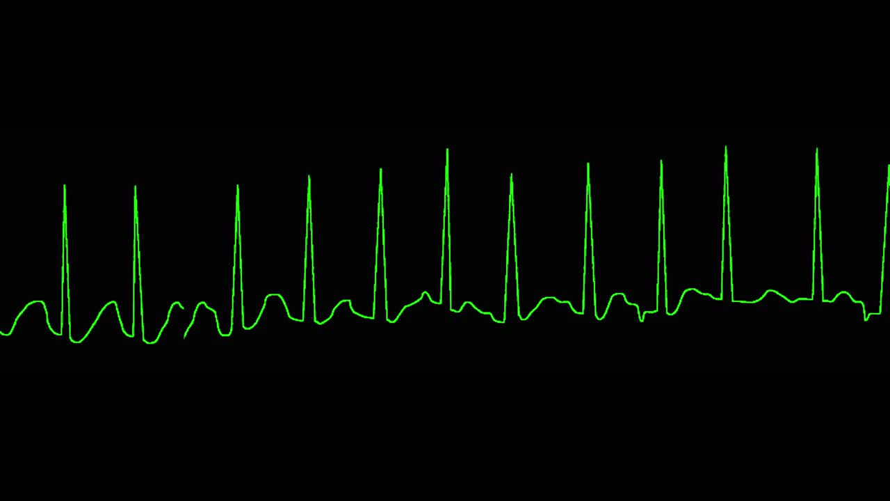 ecg는 다중 초점 심장 태키카디 (mat) 를 나타니다.