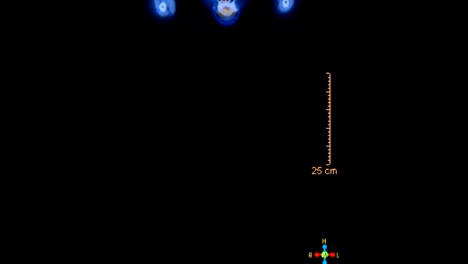 tomografía por emisión de positrones (pet) de todo el cuerpo humano para encontrar la vista coronal recurrente del tumor.