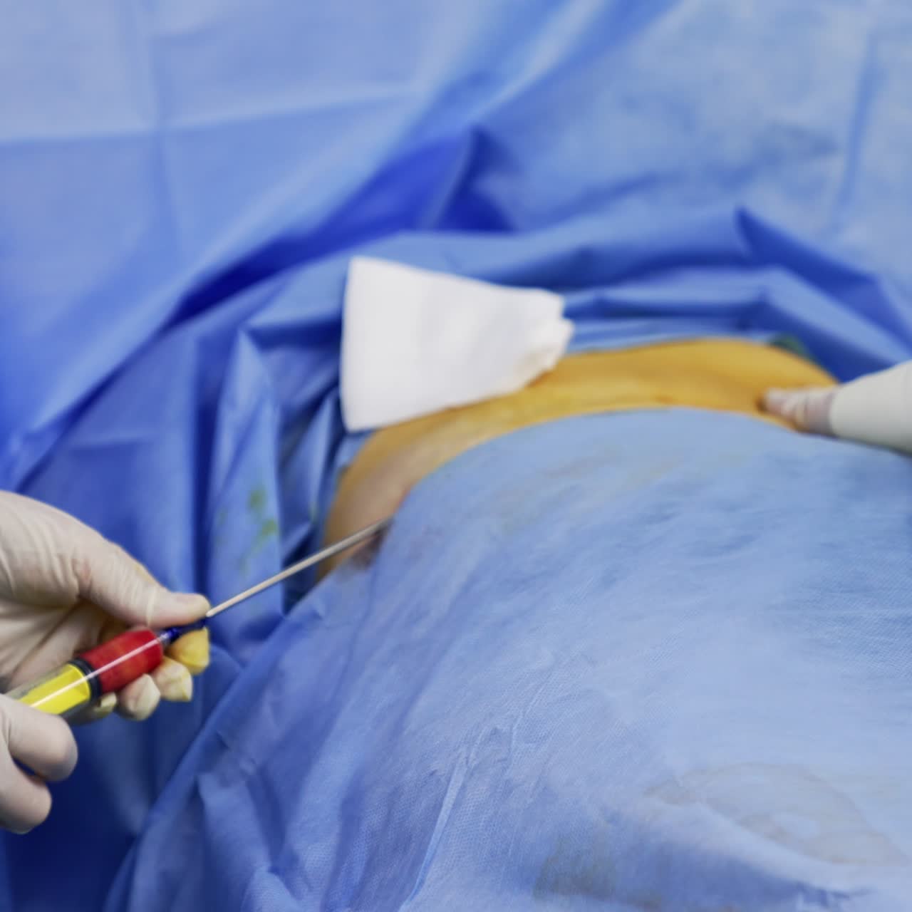 Gloved hands of surgeon shove the syringe with huge needle into patient's body. Close up. Stem cell operation in modern clinics