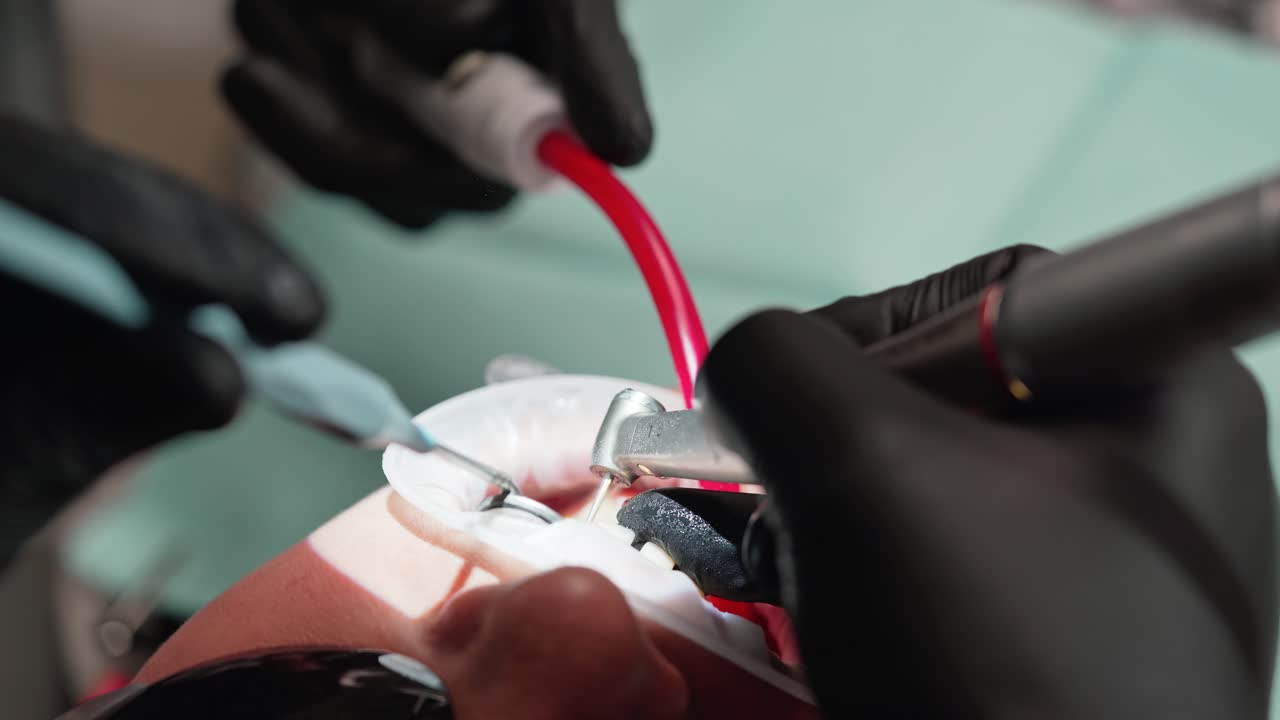 Patient's face during tooth treatment at dentist's clinic. Hands in black gloves of a stomatologist treating client's teeth with dental instruments. Close-up.