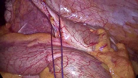 cirugía de apendicitis