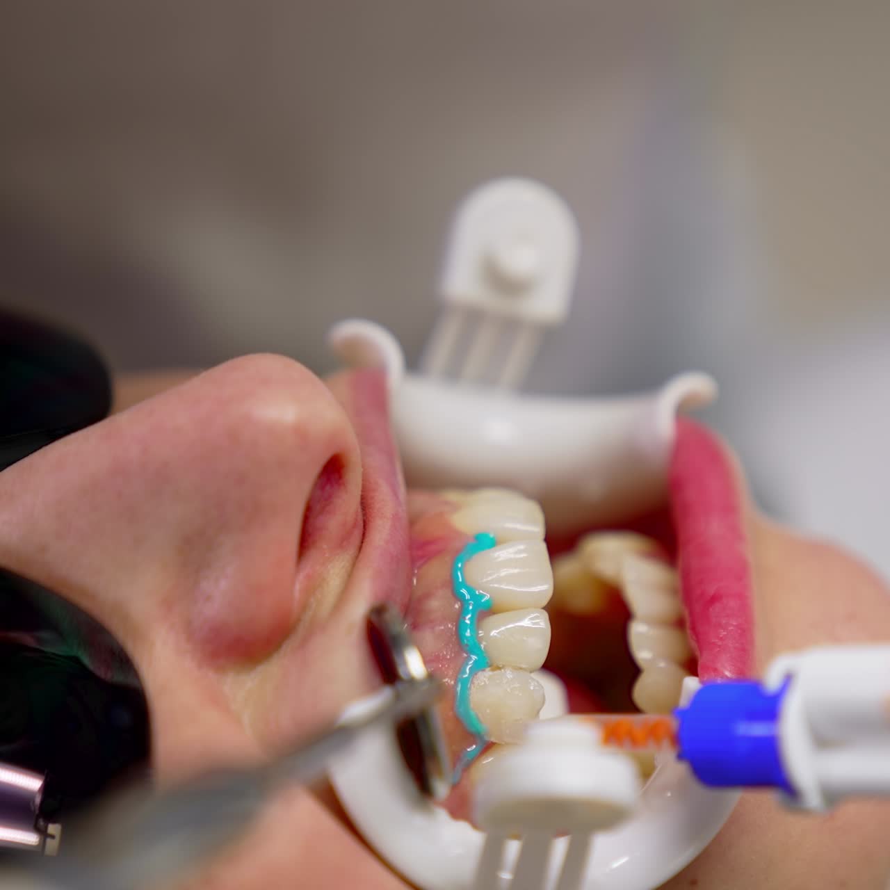 Modern dental process on female's teeth. Face of a woman in black glasses with opened mouth during stomatology procedure on her teeth with medical tools. Close-up