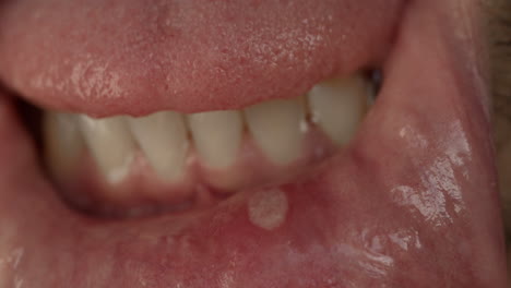 Close up shot of a small injury in the mouth, lower lips