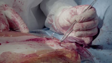 medical staff of the operating unit do heart surgery the nurse assists in performing the operation suturing a wound