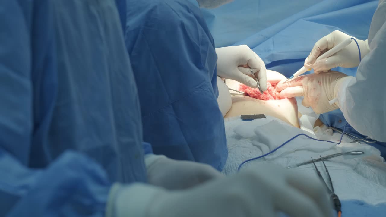 Breast removal surgery under the guidance surgeons team, preparation for breast implant placement