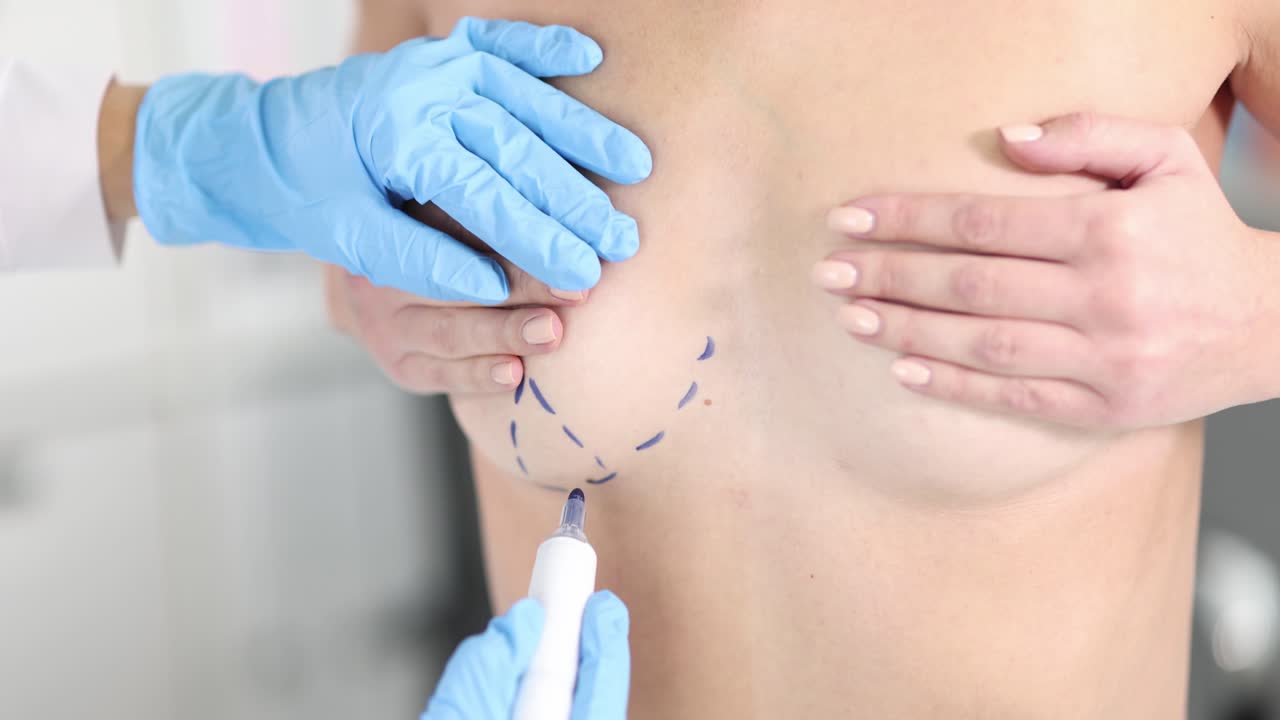 corpo di donna con segni chirurgici blu sul petto