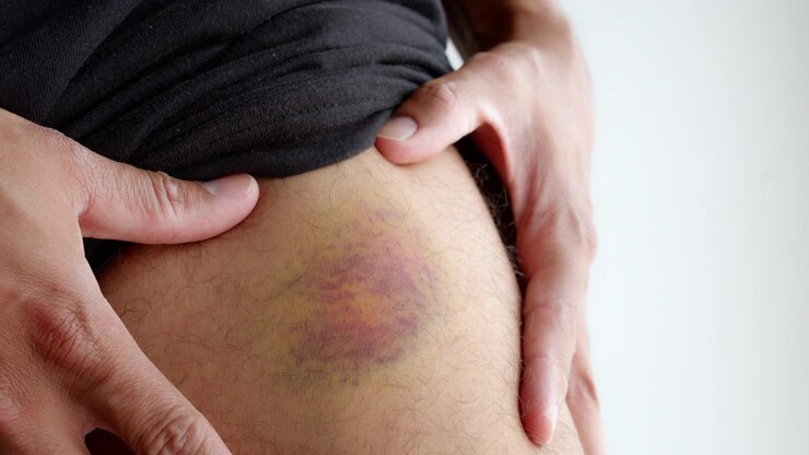 Man pulling up his shorts to show a large colorful bruise on his upper thigh