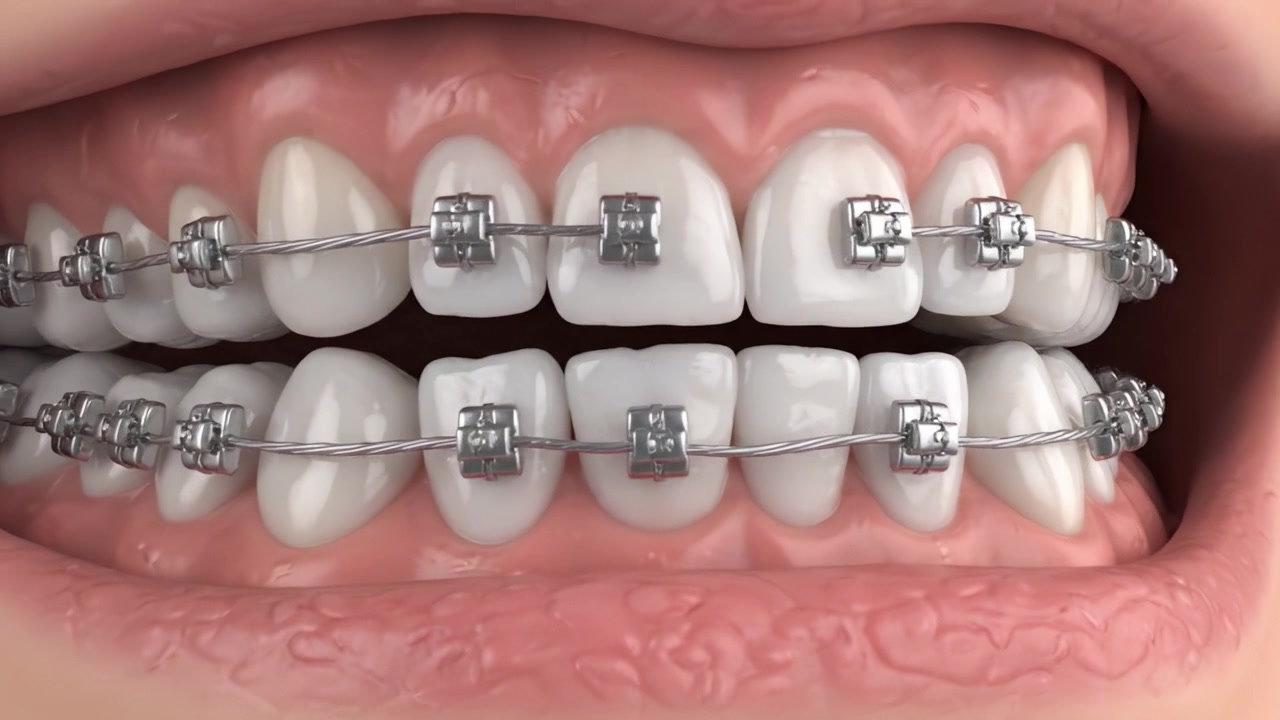 Transformation of Teeth Through Orthodontic Braces: A Close-Up View of the Initial and Final Stages of Teeth Alignment and Straightening in a Patient's Mouth