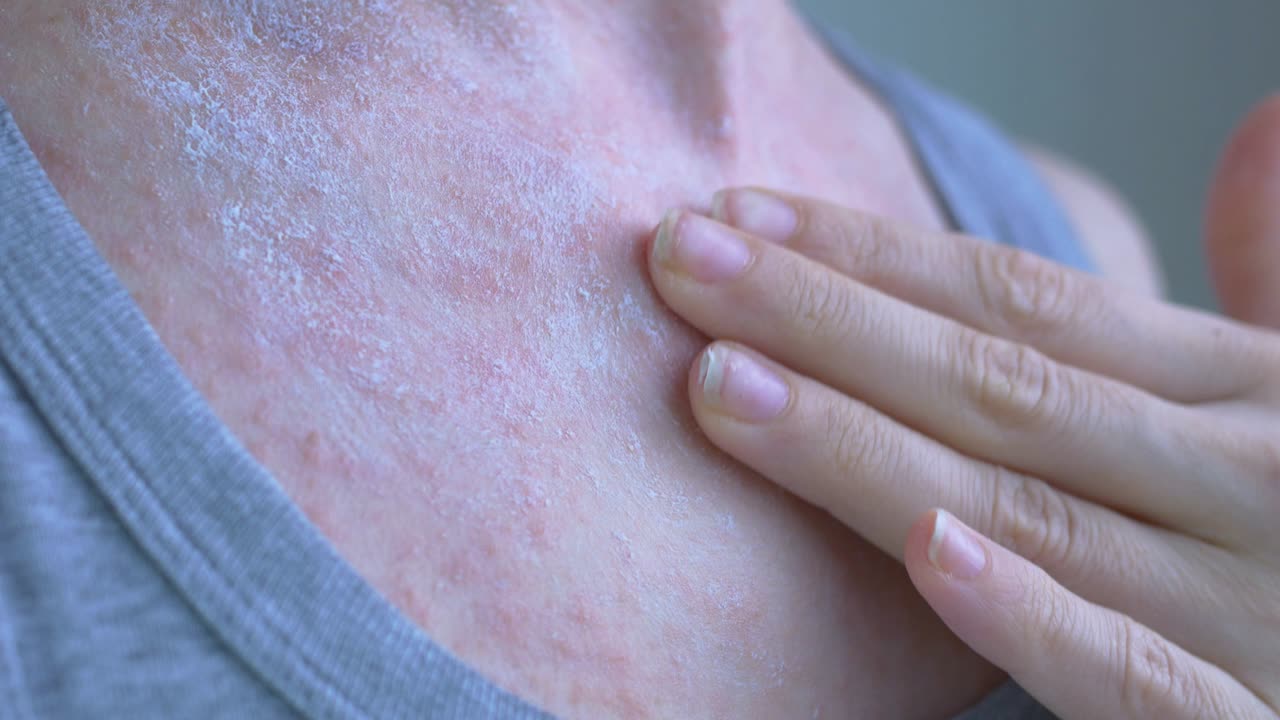 On the upper part of the womans chest, a reddened rash. White ointment was applied to the area. The ointment is rubbed into the skin in a circular motion. Viral diseases. Close-up