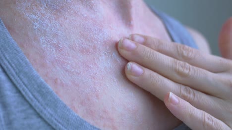 on the upper part of the womans chest, a reddened rash. white ointment was applied to the area. the ointment is rubbed into the skin in a circular motion. viral diseases. close-up