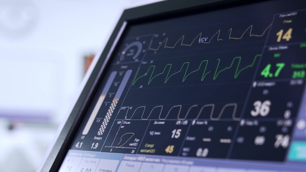 Linee curve scorrono sul monitor della macchina per la ventilazione polmonare. Controllo delle condizioni del paziente durante la neurochirurgia. Primo piano.