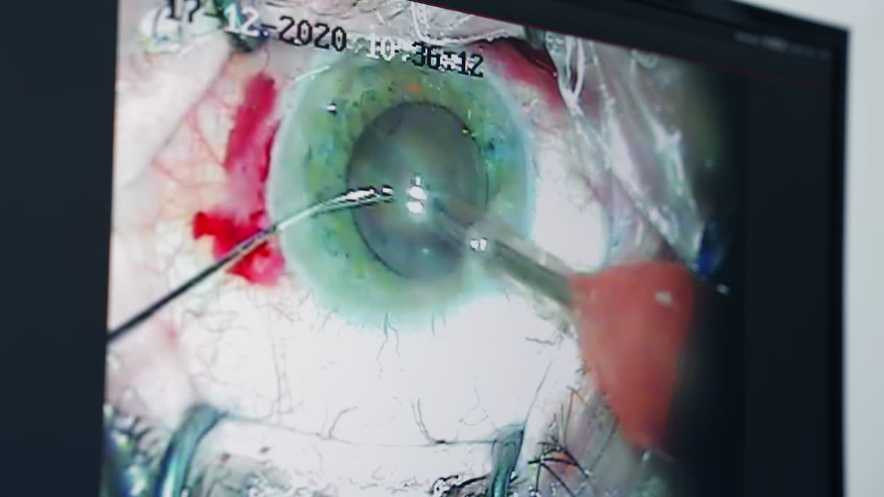 Eye with ophtalmology surgery tools. Surgery operation in modern clinic. Vision correction surgical treatment.