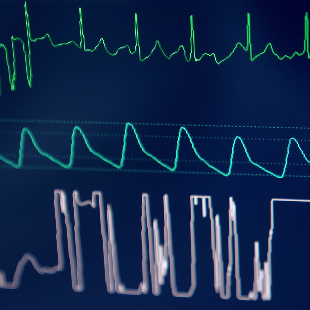 Curves of life signs running on the blue screen. Close up. Equipment working in the operational room at surgery