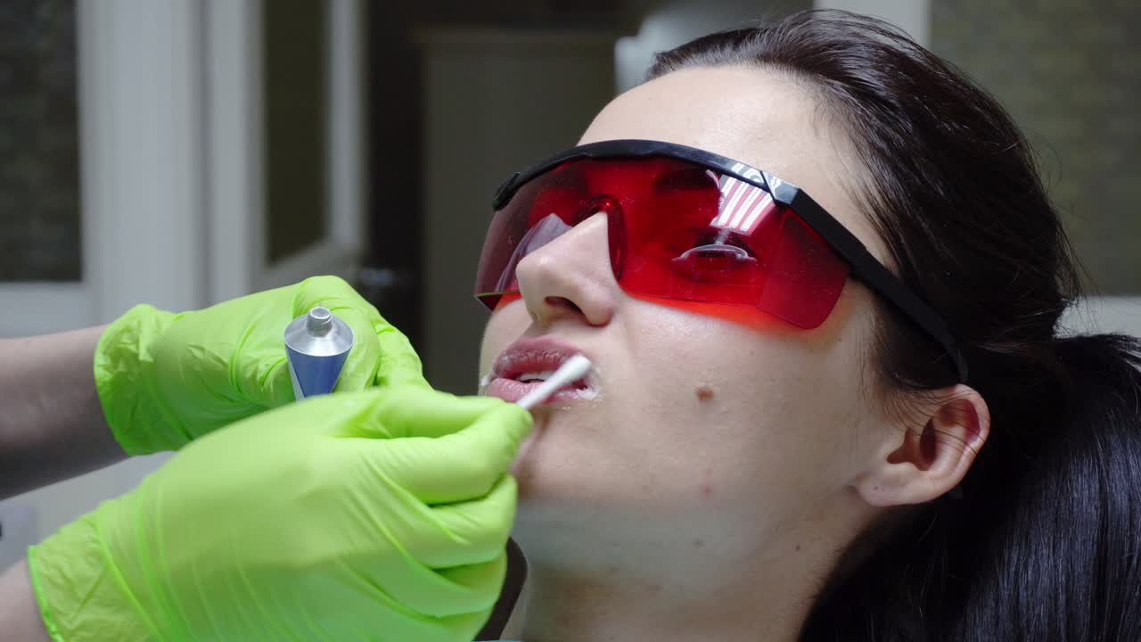 Closeup view of the dentist's hands taking on special protective treatment on the lips of a female patient before putting rubber dam. Shot in 4k